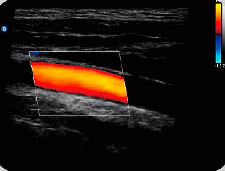 ECO 6 carotida 2Steer